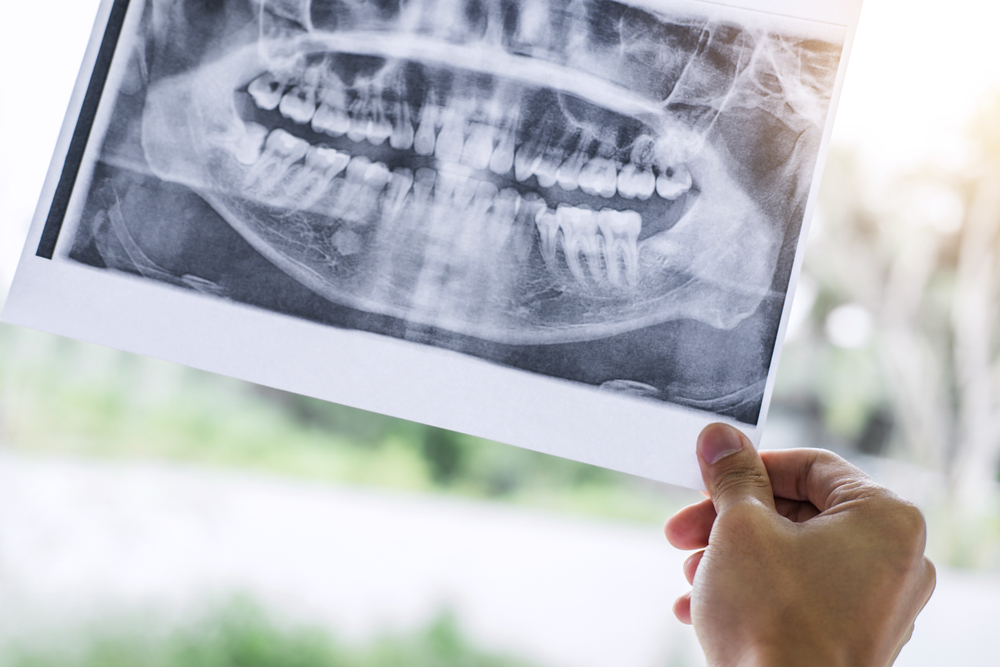 A person's hand holding up a large panoramic dental X-ray film outdoors, displaying a complete view of the upper and lower teeth, jawbone, and sinus cavities.
