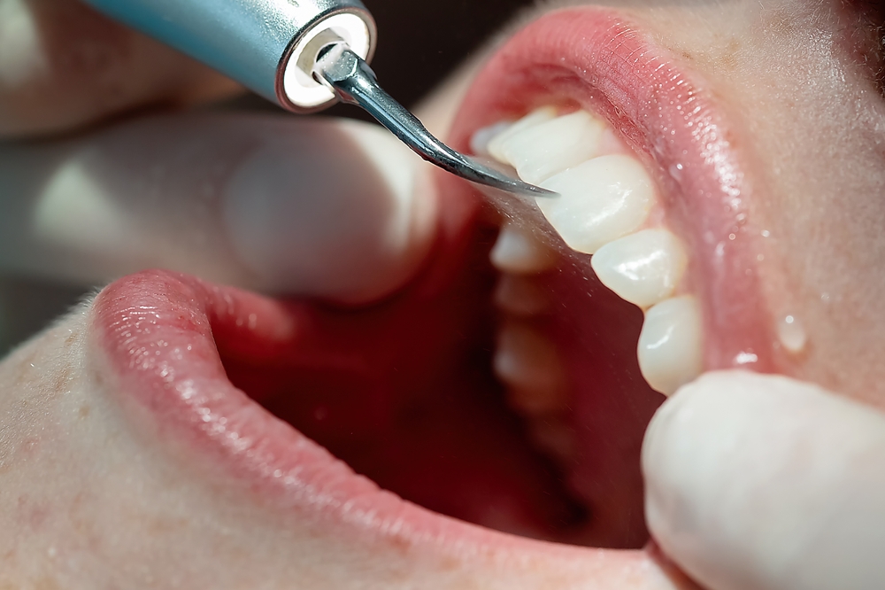 Extreme close-up of an ultrasonic dental scaler removing plaque and tartar from a patient's upper teeth during a professional cleaning.