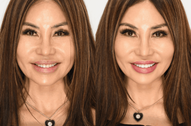 New 3D Composite Veneers 11