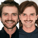 New 3D Composite Veneers 5 scaled