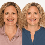 New 3D Composite Veneers 9 scaled