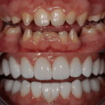 New Porcelain Veneers 18 scaled