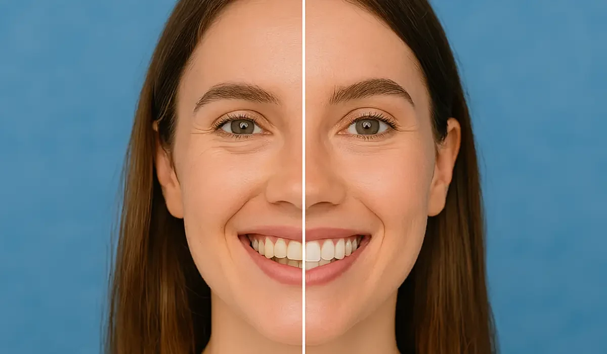 Before and after teeth whitening result showing natural bright smile and healthy enamel.