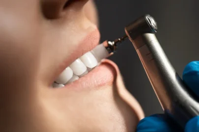 Dentist polishing teeth during a routine dental cleaning visit, showing what dental cleaning cost includes for plaque removal and enamel protection