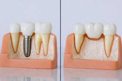 Dental implants vs bridges comparison showing implant with screw root and bridge supported by adjacent teeth