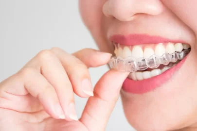 Patient placing clear aligners during Invisalign treatment while adjusting comfortably to everyday orthodontic wear