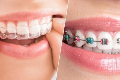 Invisalign vs Braces comparison showing clear aligners and traditional braces for teeth straightening and lifestyle differences