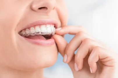 Woman placing Retainer After Invisalign to maintain straight teeth alignment and prevent shifting